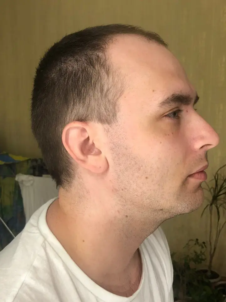 Before — hair condition prior to the transplant