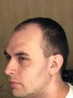 Before — side