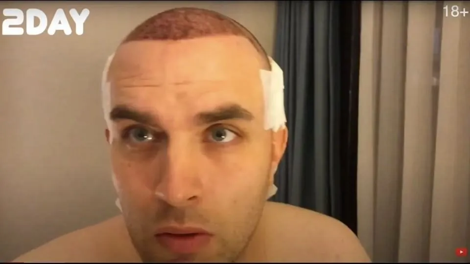 Hair transplant from day 1 to day 365